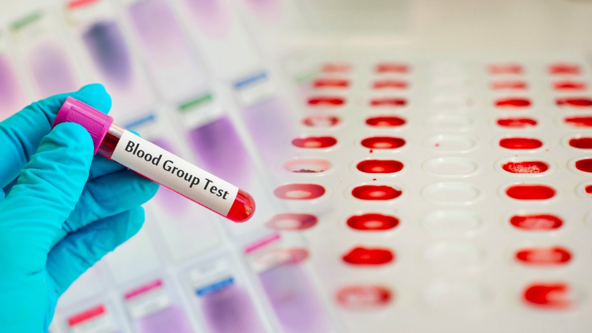 Blodgrupper kan påverka risken för att bli allvarligt sjuk i covid-19.